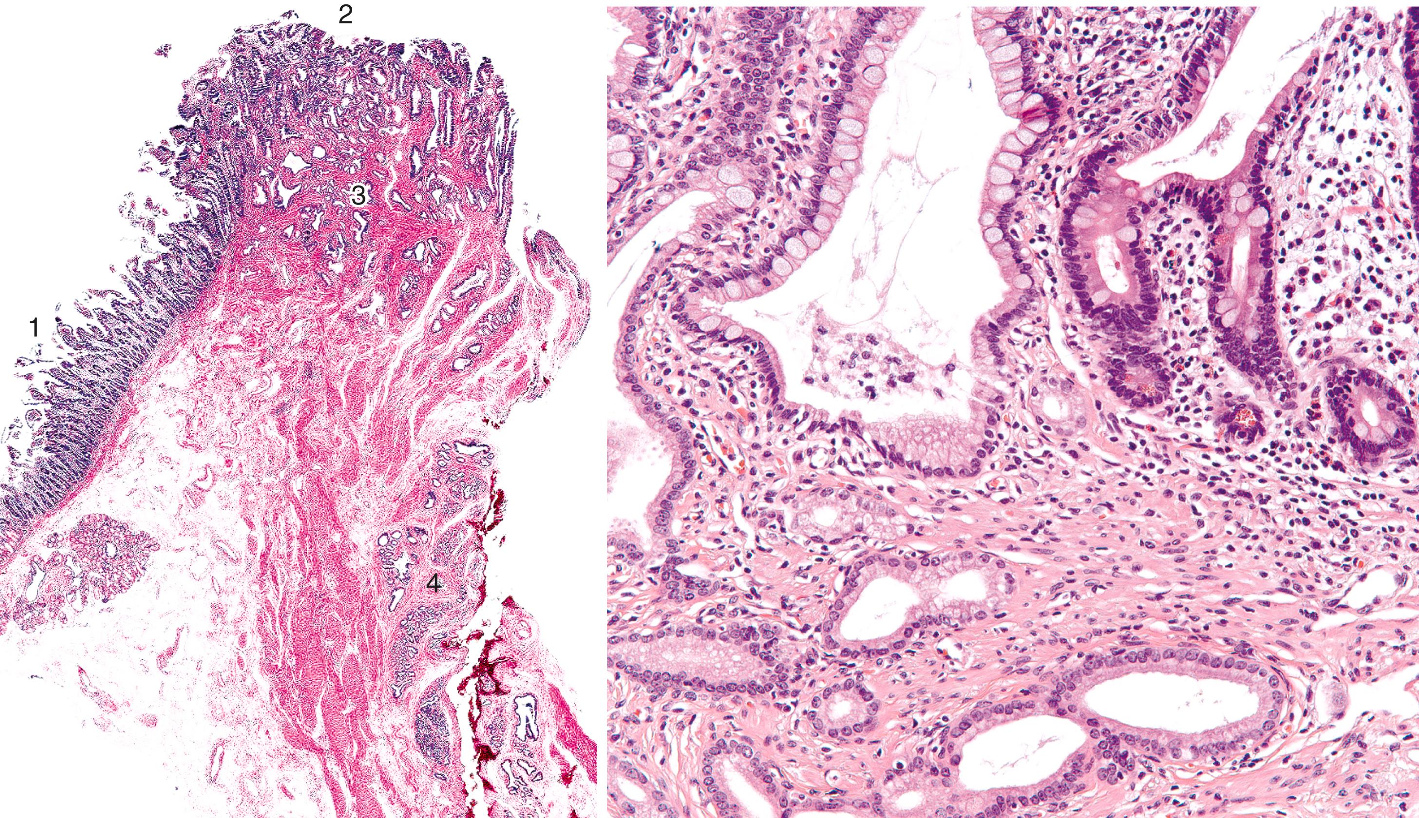 FIGURE 42.1, Histological constituents of the ampulla pertinent to tumor classification. The duodenal surface of the ampulla (1) is lined by intestinal epithelium. The papilla of Vater (2), which is the prominence where the tips of the two ducts transition into duodenal mucosa, exhibits mixed epithelia, including specialized epithelium with mucinous features and scattered goblet cells (see Fig. 42.3). In the wall of the ampulla, pancreatobiliary-type ductules (3) are embedded in the dense musculature of the sphincter of Oddi. The very distal segments of the common bile duct and the main pancreatic duct contain various amounts of tributary ductules or peribiliary mucous glands (4).