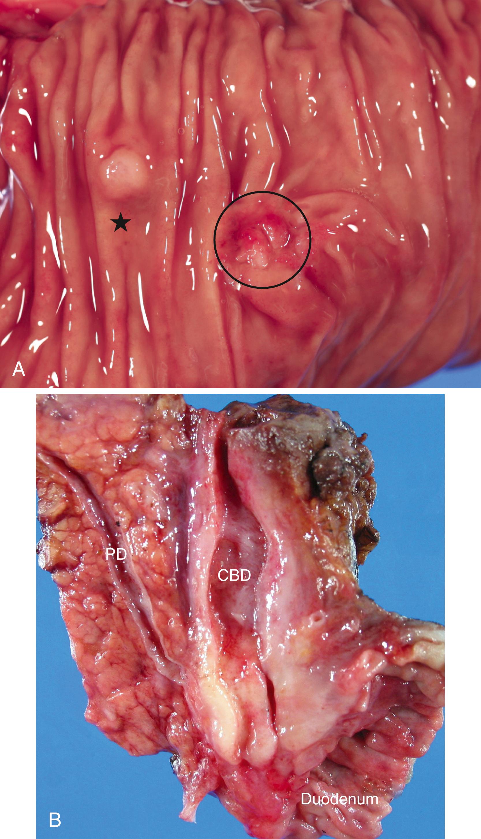 FIGURE 42.2, A, Ampullary duct carcinomas (circle) are characterized by relatively subtle changes from the duodenal perspective. The mucosal-covered elevation may be irregular or ulcerated. Note the minor ampulla (star). B, On sectioning, ampullary duct carcinomas typically reveal plaquelike firmness in the wall of the ampulla. CBD , Distal end of the common bile duct; PD , the main pancreatic duct.