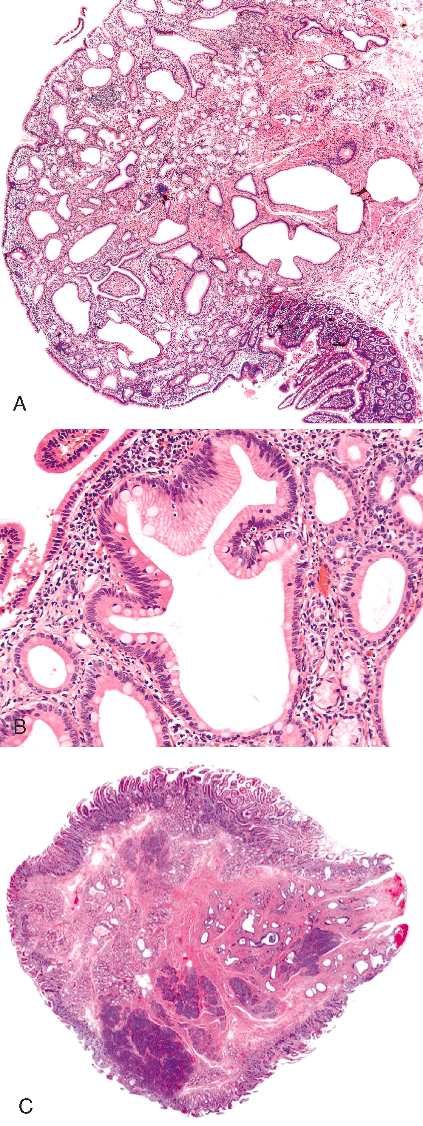 FIGURE 42.3, The minor papilla is similar to the major papilla morphologically. It shows intestinal-type mucosa that transitions into a papilla, which is composed of pancreatobiliary-type ductules (A) and specialized epithelium with mucinous features and scattered goblet cells (B). Pancreatic lobules (C) and clusters of neuroendocrine cells may be seen on the wall of the minor papilla.