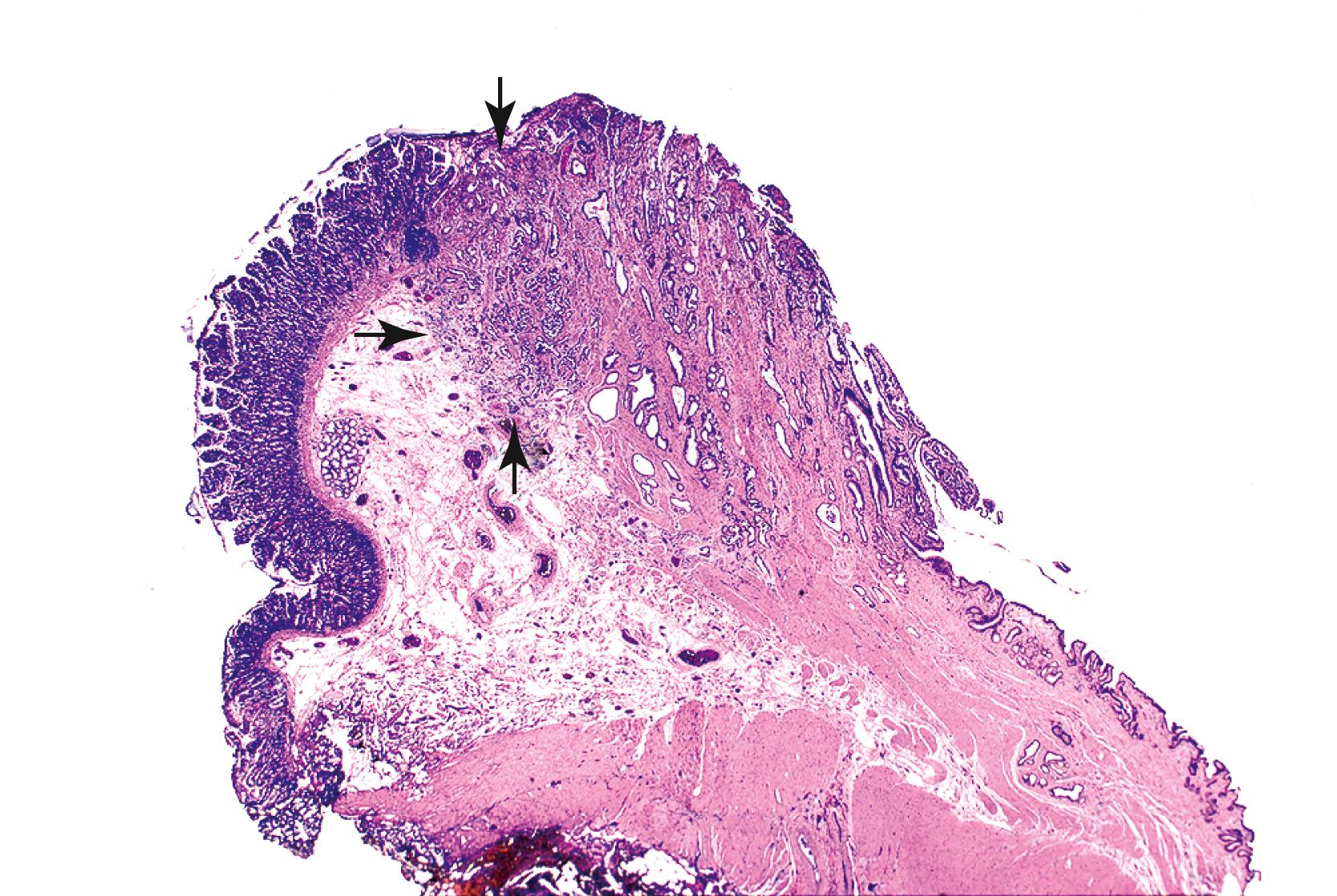 FIGURE 42.7, Early-stage ampullary adenocarcinoma arising in the papilla of Vater (i.e., ampullary carcinoma, not otherwise specified).