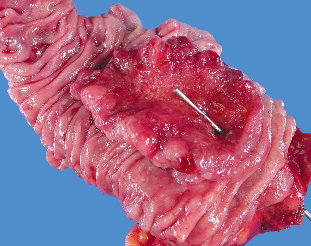 FIGURE 42.5, Carcinomas of the ampullary duodenum manifest as ulcerovegetative tumors.