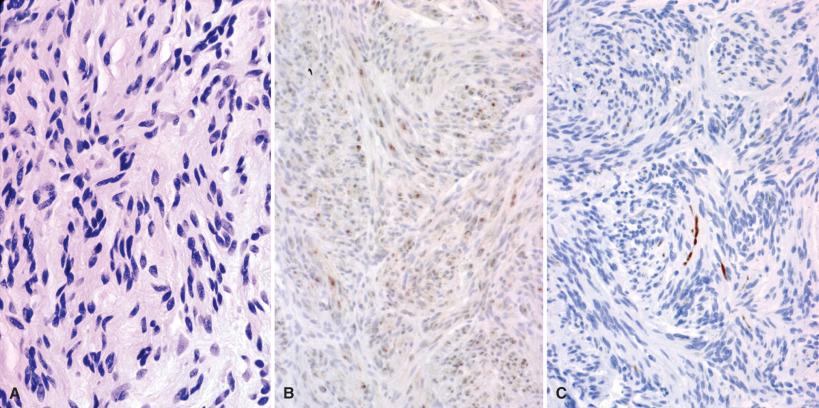 Fig. 15.11, Palisaded encapsulated (“solitary circumscribed”) neuroma. These relatively cellular proliferations (A) consist of S-100 protein reactive Schwann cells (B), usually outnumbering neurofilament positive axons (C).