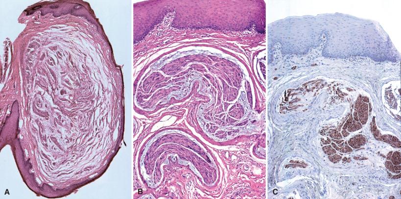 Fig. 15.12, Mucosal neuromatosis in MEN-IIb. This somewhat polypoid example (A) consists of nerve with stromal mucin (B) and a full complement of Schwann sheaths (C, S-100 protein stain) and axons.