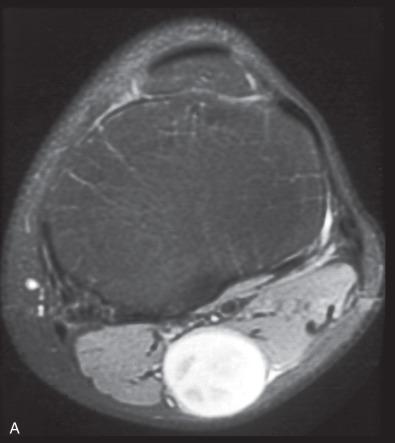 Fig. 15.13, Schwannoma on imaging. On MRI (A), this popliteal lesion is strongly enhancing. A CT scan of a giant sacral example shows marked remodeling of surrounding bone (B). A vestibular schwannoma on postcontrast MRI shows nipple-like dilation of the auditory canal (C).