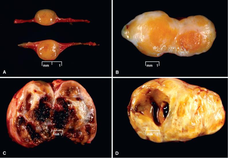 Fig. 15.14, Schwannoma. Gross features include globular enlargement of a fascicle (A), yellow coloration of the cut surface due to lipid accumulation (B), hemorrhage within the substance of the tumor (C), and cystic transformation (D).