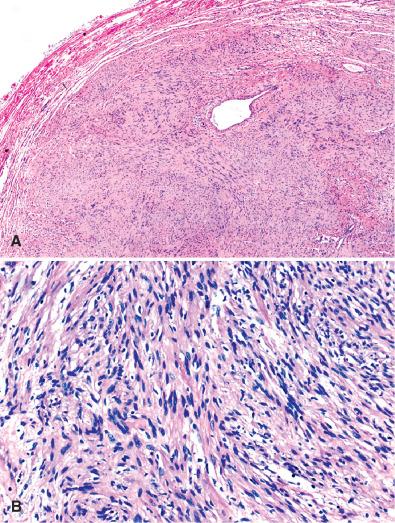 Fig. 15.16, Schwannoma. Note the presence of a capsule (A) around a largely spindle cell neoplasm (B).