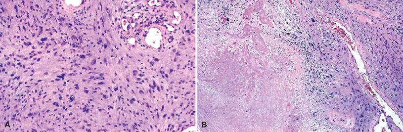 Fig. 15.18, Schwannoma. Degenerative nuclear atypia, although common in large, longstanding tumors, is of no clinical significance (A). The same is true of necrosis (B).