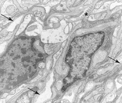 Fig. 15.20, Schwannoma. Ultrastructurally the tumor shows processes coated with continuous basal lamina (arrows), as well as the formation of long spacing collagen or Luse bodies (asterisk).