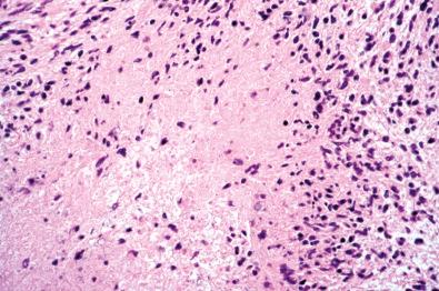 Fig. 15.23, Cellular schwannoma. Microfoci of necrosis may be observed but lack palisading.