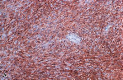 Fig. 15.24, Cellular schwannoma. The immunophenotype includes uniform S-100 protein staining (A), reactivity for collagen IV (B), extensive SOX10 reactivity (C), and peripherally incorporated axons on neurofilament protein preparation (D). The presence of a focally elevated Ki-67 labeling index (E) and scattered p53 positivity (F) should not prompt a change in diagnosis to MPNST.