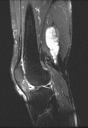 Fig. 15.25, Plexiform/multinodular schwannoma. This MRI scan shows the multinodularity of the lesion.