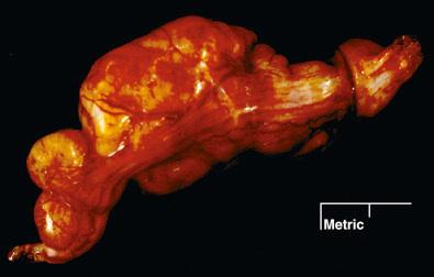 Fig. 15.26, Plexiform/multinodular schwannoma. Note the expansile nodules arrayed along the axis of the nerve.