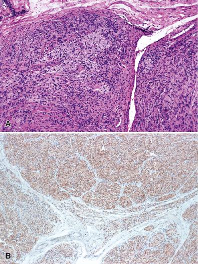 Fig. 15.27, Plexiform/multinodular schwannoma. Two adjacent involved fascicles are shown (A). Such tumors show uniform S-100 protein immunoreactivity (B).