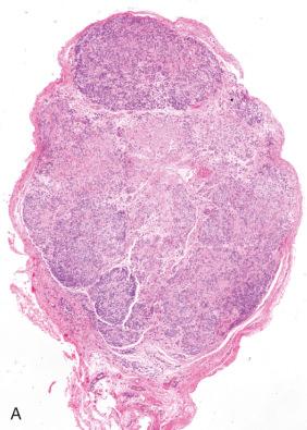 Fig. 15.28, Epithelioid schwannoma. Note circumscription, plump cells, and a somewhat mucoid stroma (A). Lobular architecture (B) and prominent nucleoli (C) are additional features.