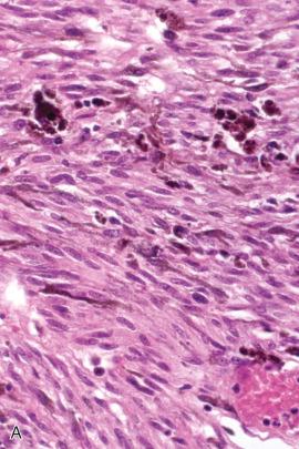 Fig. 15.30, Melanotic schwannoma. The tumor cells vary considerably in pigmentation (A, B) as well as in configuration, ranging from spindle to epithelioid (C).