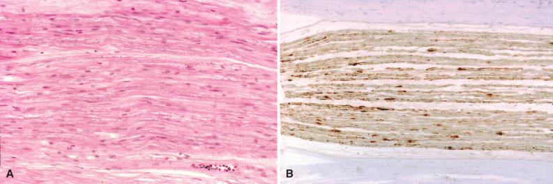 Fig. 15.3, Normal spinal nerve showing a longitudinal section of a fascicle (A). Note alignment of Schwann cells and barely discernible axons. S-100 protein immunopositive Schwann cells represent the main cellular constituent (B). Neurofilament protein immunostaining of a fascicle cross section shows variation in axonal diameter (C). The latter is reflected in the thickness of the myelin layer on Luxol fast-blue stain (D).