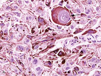 Fig. 15.31, Psammomatous melanotic schwannoma. Note the presence of laminated calcifications (A) and lipid accumulation (B).