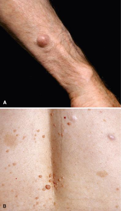 Fig. 15.33, Localized cutaneous neurofibromas may be isolated, nonsyndromic lesions (A) or multiple and associated with café-au-let spots in the setting of NF1 (B).