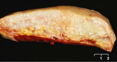 Fig. 15.34, Diffuse cutaneous neurofibroma. Note the marked expansion of dermal and subcutaneous tissue.