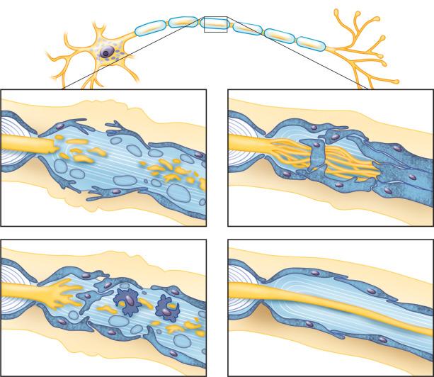 Fig. 15.4, Steps in axonal degeneration and regeneration.