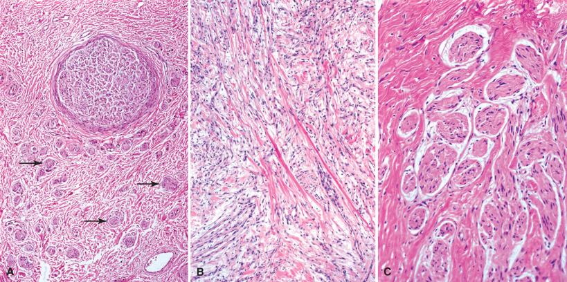 Fig. 15.6, Traumatic neuroma. Note one intact fascicle surrounded by a proliferation of new nerve fibers, some organized as microfascicles (arrows) (A). Portions of such neuromas without obvious microfascicles may superficially resemble neurofibroma (B). With time the well-formed microfascicles come to lie in a collagenous stroma (C).