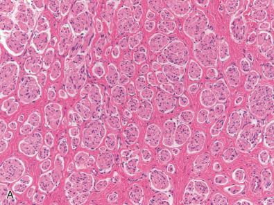 Fig. 15.7, Traumatic neuroma. Immunostains clearly show that the microfascicles (corresponding H & E) (A) contain neurofilament protein reactive axons (B), S-100 protein positive Schwann sheaths (C), and a delicate surface layer of EMA staining perineurium (D).