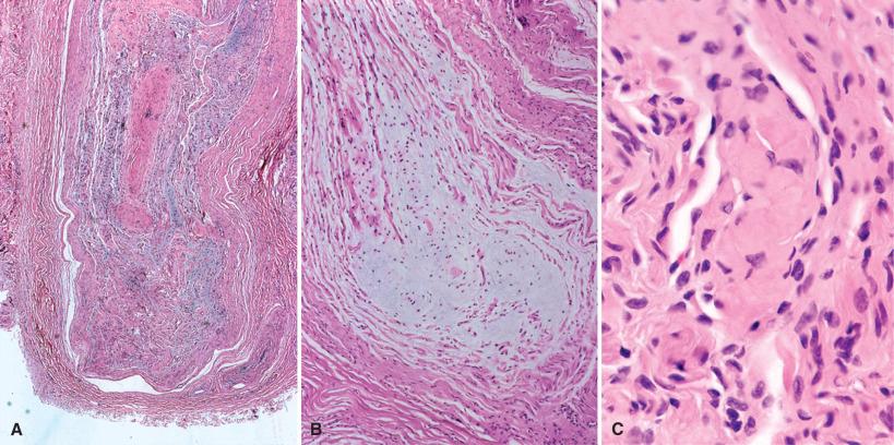 Fig. 15.8, Morton neuroma. Note thickening of the perineurium (A), pallor of the edematous nerve fascicle (B) and balls of collagen (C), all signs of a chronic reaction.