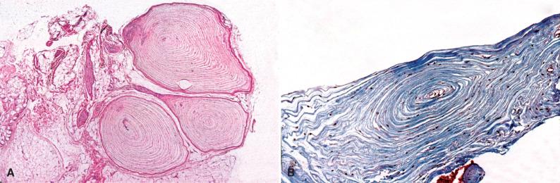 Fig. 15.9, Pacinian neuroma typically consist of multiple hypertrophic corpuscles (A). With time, these may become collagenous as seen on Masson trichrome stain (B).