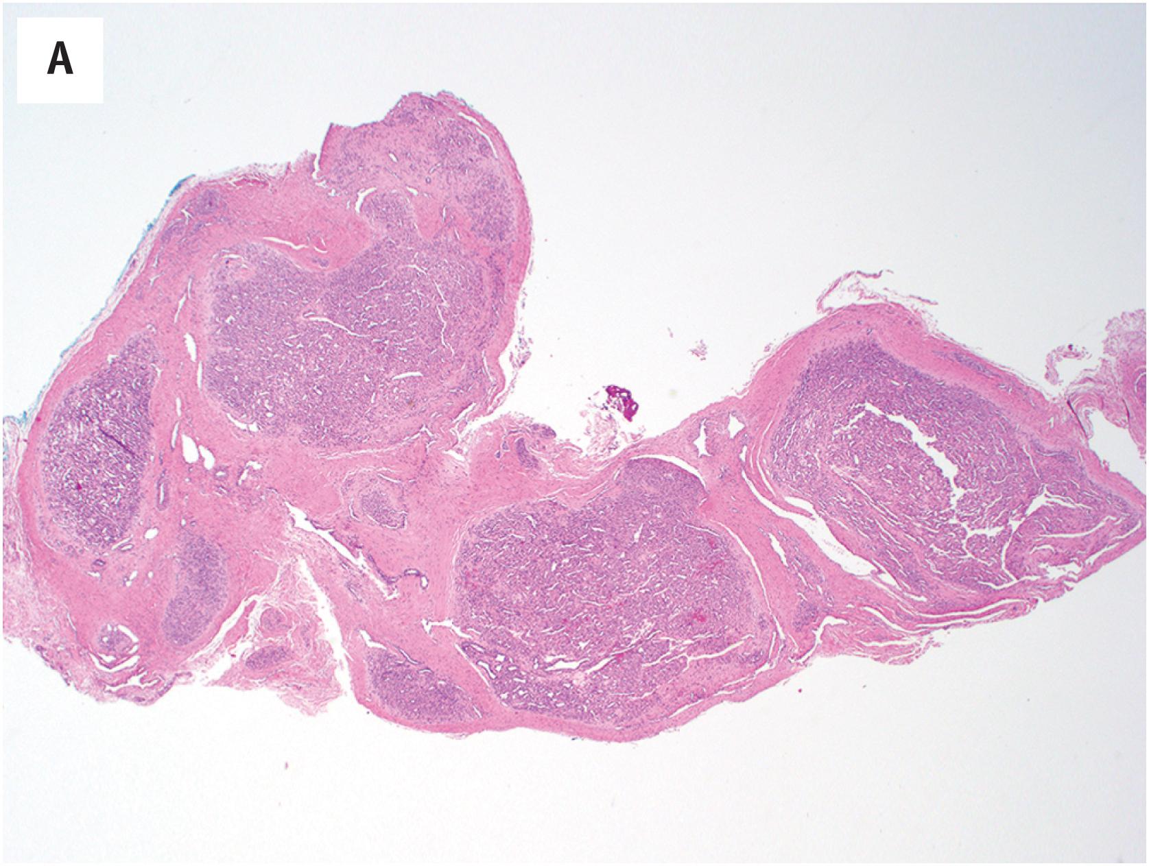 Fig. 8.4, (A) Myopericytoma often has a lobular or nodular growth pattern, centered on medium-sized vessels. (B) Myopericytoma is composed of myoid-appearing spindled to ovoid cells arranged around many small vessels, which may be rounded (B), or have slit-like or branching/hemangiopericytomatous pattern (C). (D) Concentric perivascular growth is a characteristic feature of myopericytoma.