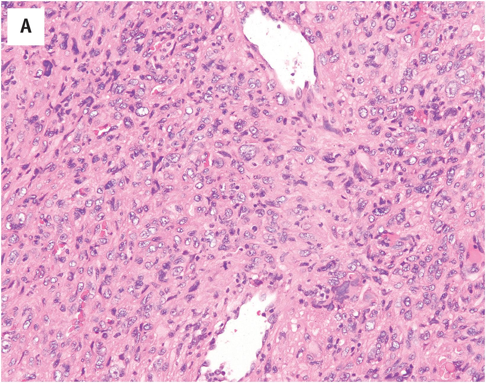 Fig. 8.5, (A) Malignant myopericytoma, with highly malignant-appearing, mitotically active myoid cells growing in a concentric fashion around thick-walled vessels. (B) “Myopericytomatosis:” each of these slides is from a discrete myopericytoma, located throughout the subcutis and muscle in the leg of a young adult male.