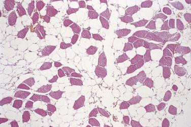 FIG. 24.1, Intramuscular lipoma. Typical example showing infiltration of mature fat cells between muscle fibers.