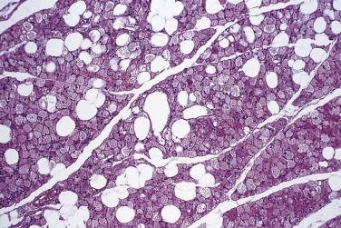 FIG. 24.11, Hibernoma. Note the lobular pattern and mixture of granular eosinophilic cells and adipocytes.
