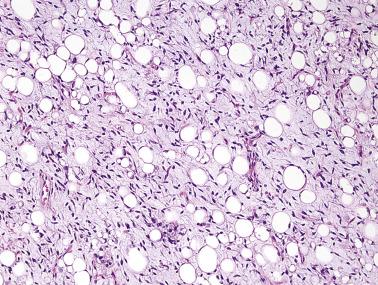 FIG. 24.12, Atypical spindle cell lipomatous tumor. Spindle cells with mildly hyperchromatic nuclei admixed with adipocytes of varying size and scattered lipoblasts.