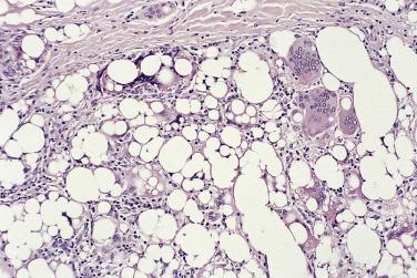 FIG. 24.13, Silicone granuloma. The presence of foreign-body giant cells is a helpful diagnostic clue.