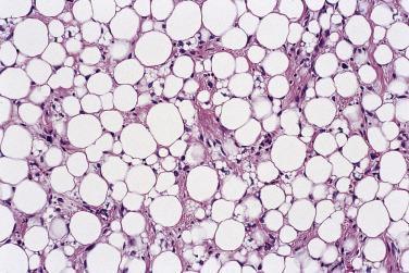 FIG. 24.14, Well-differentiated adipocytic liposarcoma. Note variation in adipocyte size, hyperchromatic nuclei, and scattered lipoblasts.