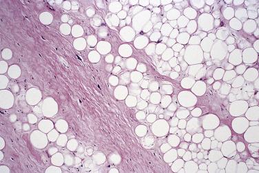 FIG. 24.15, Well-differentiated adipocytic liposarcoma. The fibrous septa often contain bizarre stromal cells.