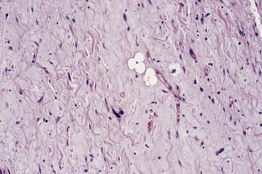 FIG. 24.16, Well-differentiated sclerosing liposarcoma. Note the fibrillary quality of the collagen and the rarity of lipoblasts.