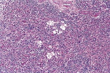 FIG. 24.17, Well-differentiated inflammatory liposarcoma. Small clusters of lipoblasts are present in a sea of chronic inflammatory cells.