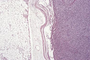 FIG. 24.18, Dedifferentiated liposarcoma. Abrupt transition between the two components is common.