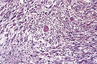 FIG. 24.20, Dedifferentiated liposarcoma with heterologous rhabdomyosarcomatous component. Note the large polygonal rhabdomyoblasts.