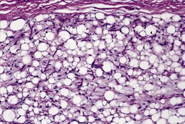 FIG. 24.2, Lipoblastoma. Note the lack of nuclear atypia, myxoid stroma, and crow's feet vessels.