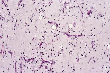 FIG. 24.21, Myxoid liposarcoma. Characteristic crow's feet vessels, small undifferentiated cells, and lipoblasts.