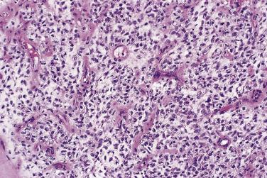 FIG. 24.24, Round cell liposarcoma. Note that there are still identifiable crow's feet vessels.