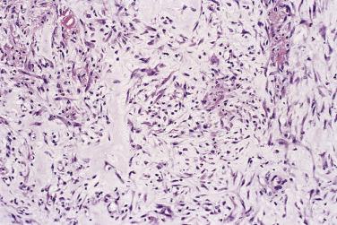 FIG. 24.27, Visceral reactive myofibroblastic proliferation. This fasciitis-like lesion was located close to the pancreas and later regressed spontaneously.