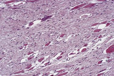 FIG. 24.28, Fibromatosis colli. Morphologically, these lesions resemble cellular scar tissue associated with degenerate muscle.