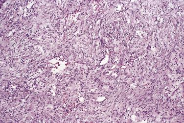 FIG. 24.29, Nodular fasciitis. Typical feathery appearance with microcystic degeneration.