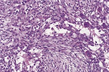 FIG. 24.30, Nodular fasciitis. Plump, mitotically active myofibroblasts characterize this lesion. Note the osteoclast-type giant cells in this case.