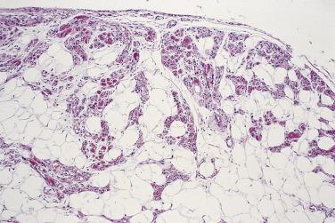 FIG. 24.3, Angiolipoma. Note that vessels are mainly peripheral and contain fibrin microthrombi.