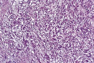 FIG. 24.31, Proliferative fasciitis. Note the plump, basophilic ganglion-like cells.