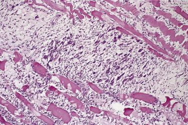 FIG. 24.32, Proliferative myositis. Note the relative preservation of muscle fibers.